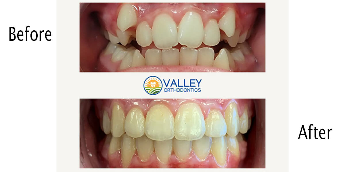 Interceptive Orthodontics
